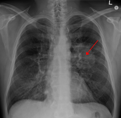Lung carcinoma